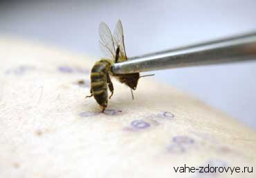 Апитерапия - лечение пчёлами