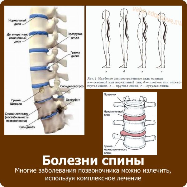 Болезни спины и их лечение