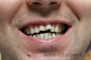 Лечение зубов стоматология
