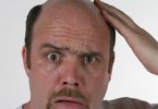 Дигидротестостерон причина облысения